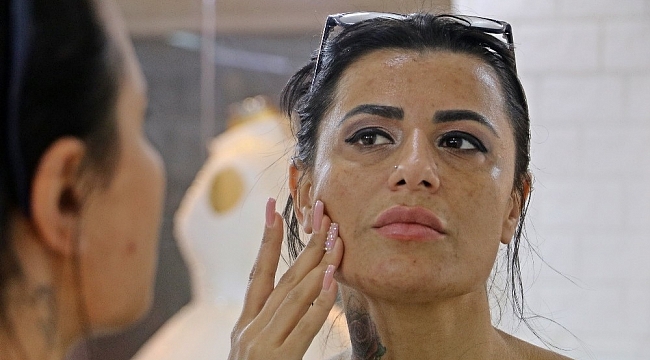 Güzelleşmek isterken yüzünde yanıklar oluşan kadın: "Gelin adaylarını görünce insanın psikolojisi bozuluyor"