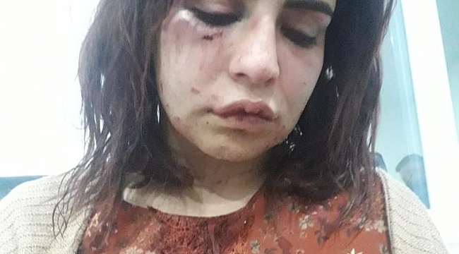 Eski sevgilisi tarafından darp edilen genç kızın "Ölmek istemiyorum" paylaşımı