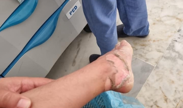 5 yaşındaki çocuk yola dökülen sıcak kül ile yandı