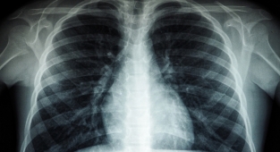 Düşük maliyetli bir ilacın Kovid-19 hastalarında akciğer zararını sınırladığı belirlendi