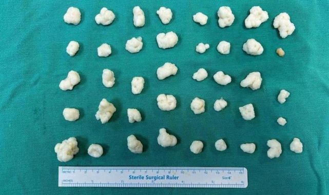 Düzce Üniversitesinden (DÜ) yapılan açıklamaya göre, diz ağrısı şikayetiyle hastaneye başvuran hastaya, ortopedi ve travmatoloji kliniğinde müdahale edildi.