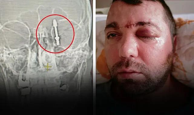 İmplant tedavisinde vida beynine saplandı!