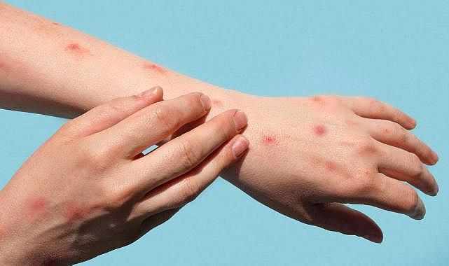 Maymun çiçeği virüsünün şimdiye kadarki en tehlikeli varyantı yayılıyor