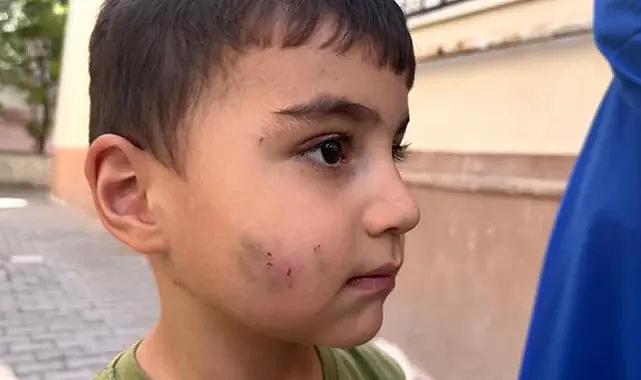 Ankara'da evinde uyuyan çocuğu lağım faresi ısırdı