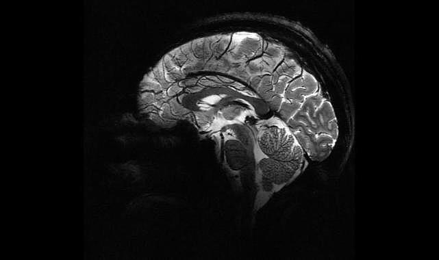 Yapay zeka, epilepsili çocuklarda doktorların gözden kaçırdığı gizli lezyonları buldu